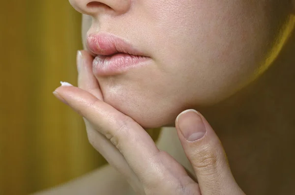 Herpes no lábio superior de uma jovem mulher — Fotografia de Stock