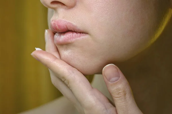 Herpes on the Upper Lip of a Young Woman