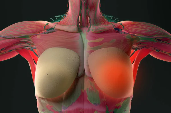 女性乳房解剖乳腺癌 — 图库照片
