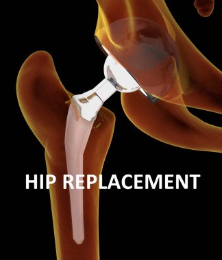 Kalça replasmanı tıbben doğru Illustration. 3D illus
