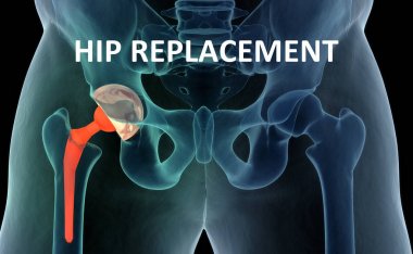 Medically accurate illustration of the hip replacement. 3d illus clipart