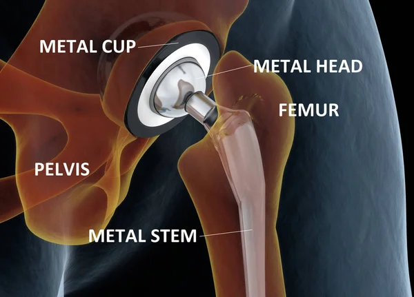 Illustrazione medica accurata della sostituzione dell'anca. 3d illus — Foto Stock