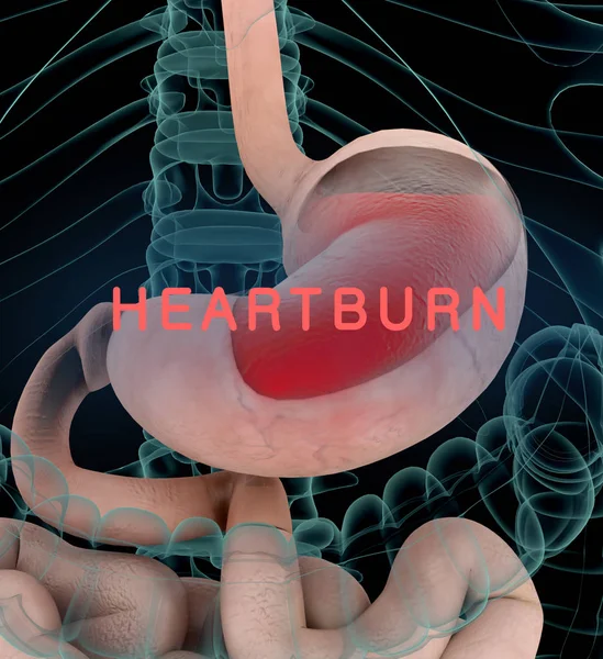 Anatomy illustration of gastric acid or heartburn, inflamed red stomach showing acid in red. 3D illustration.