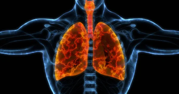 人类肺部医学图解显示 感染的肺呈明亮橙色 3D插图 免版税图库图片
