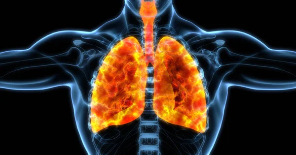 人类肺部医学图解显示 感染的肺呈明亮橙色 3D插图 免版税图库照片