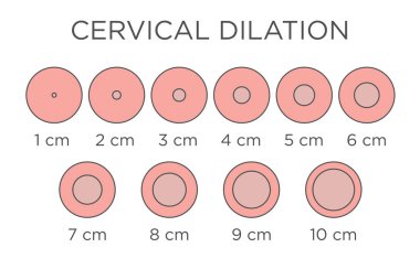 Serviyal Dilatasyon Tıbbi İllüstrasyon - santimetre grafik