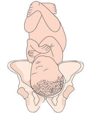 Sol Occiput Posterior Lop Bebek Fetal Pozisyon Pelvis Rop Sağ