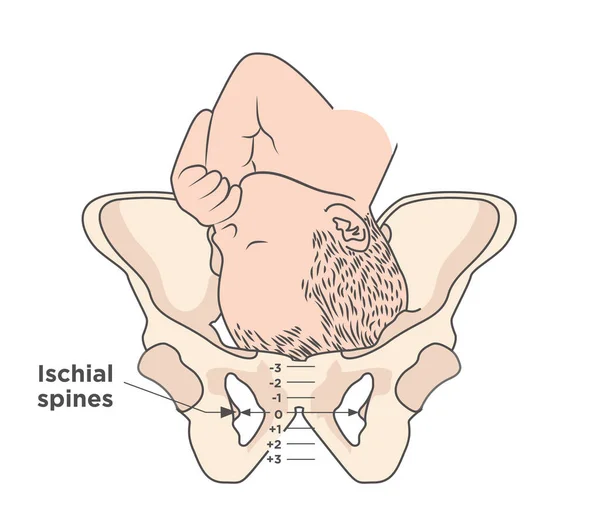 Child in womb - pelvis ischial spines - medical illustration — Stock Vector