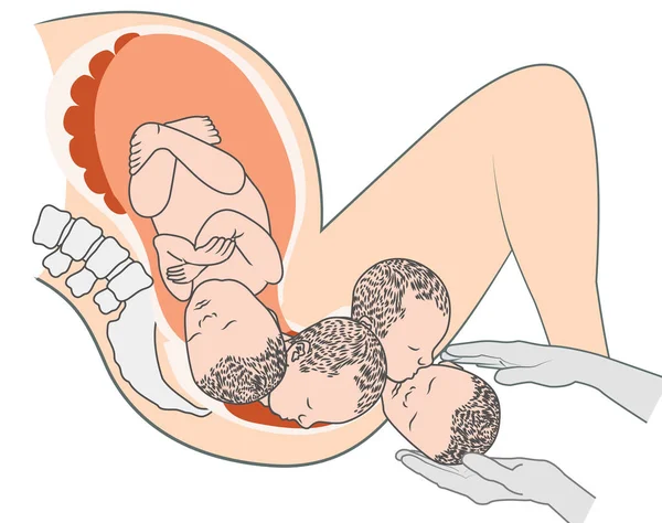 Feto de bebê na barriga da mulher grávida ilustração médica — Vetor de Stock
