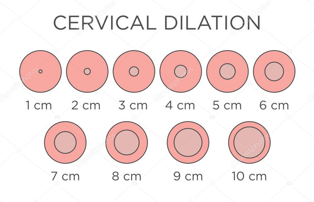 Cervial Dilation Medical Illustration - chart in centimeters