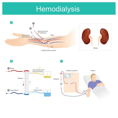 Treatment patients with chronic kidney disease. hemodialysis machine used to filter and eliminate waste that is accumulated in the blood.  clipart