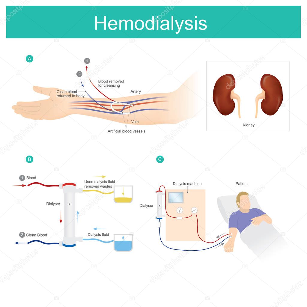 Treatment patients with chronic kidney disease. hemodialysis machine used to filter and eliminate waste that is accumulated in the blood. 