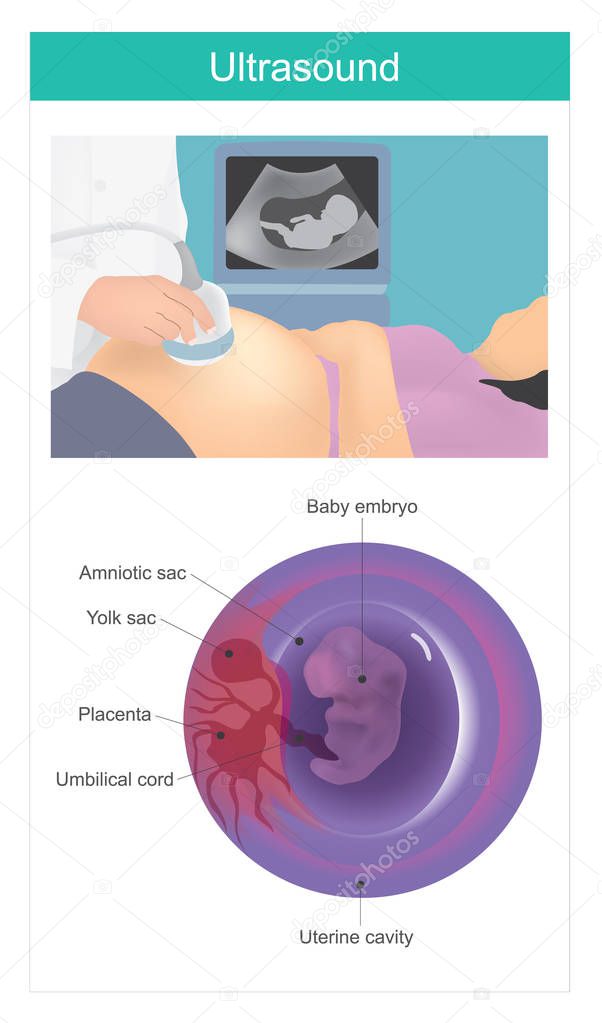 Ultrasound baby. Use of acoustic waves to Visualise the embryo in the uterine cavity.