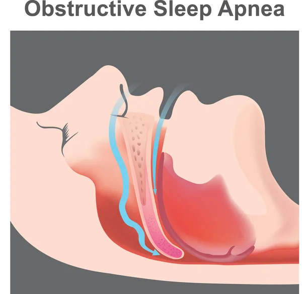 いびきは睡眠中の呼吸時に呼吸器系の構造と妨げられた空中移動のため結果として音の振動 — ストックベクタ