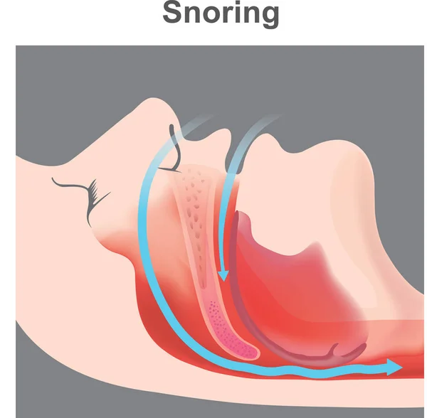 いびきは睡眠中の呼吸時に呼吸器系の構造と妨げられた空中移動のため結果として音の振動 — ストックベクタ