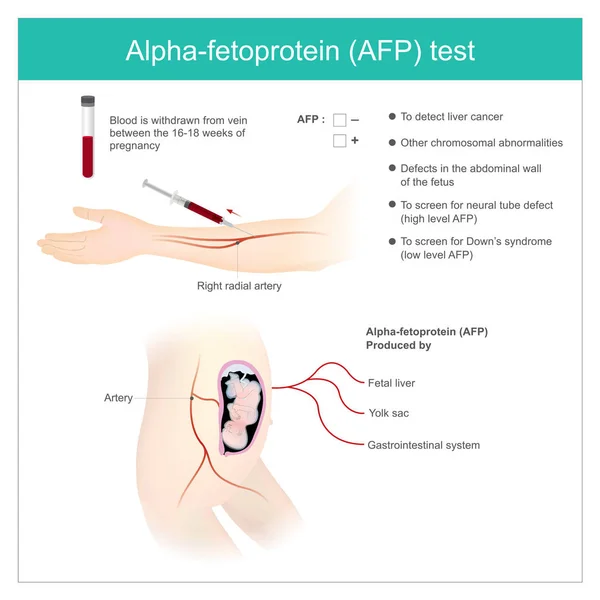 甲胎蛋白 Afp Afp 水平分析 检测肝癌 并用于筛查起伏综合征 — 图库矢量图片