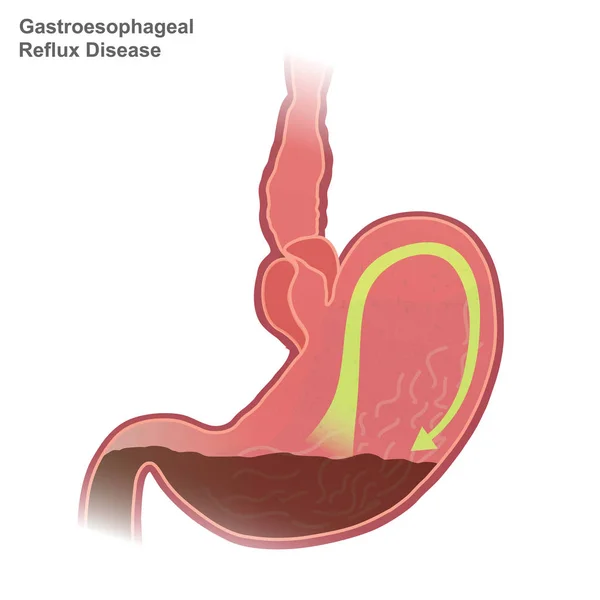 Enfermedad Por Reflujo Gastroesofágico Erge También Conocida Como Reflujo Ácido — Vector de stock