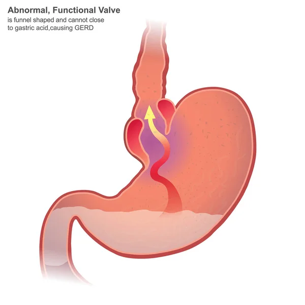 Penyakit Refluks Gastroesofageal Gerd Juga Dikenal Sebagai Refluks Asam Adalah - Stok Vektor