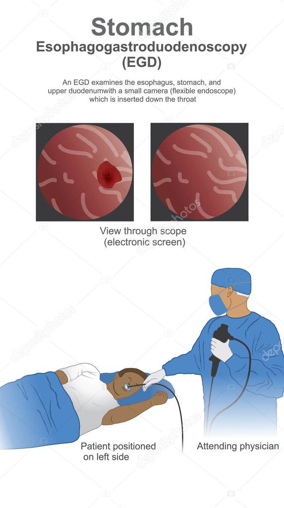 Esophagogastroduodenoscopy EGD is a test to examine the lining of the esophagus, stomach, and first part of the small intestine.