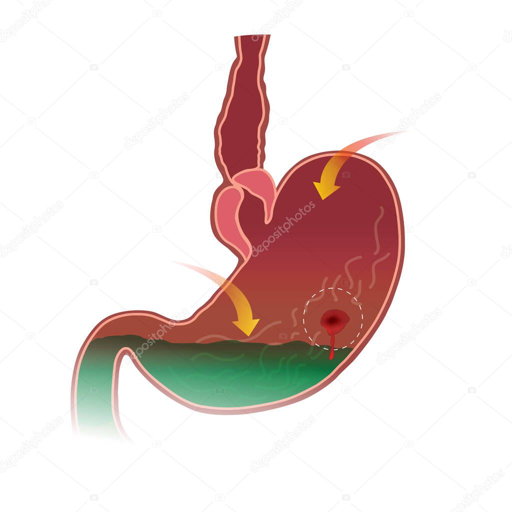 Stomach peptic ulcer. Anatomy body. Illustration.