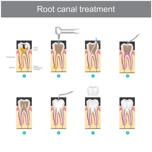 Tratamento Canal Radicular Como Tratar Nossos Dentes Depois Que Dente — Vetor de Stock