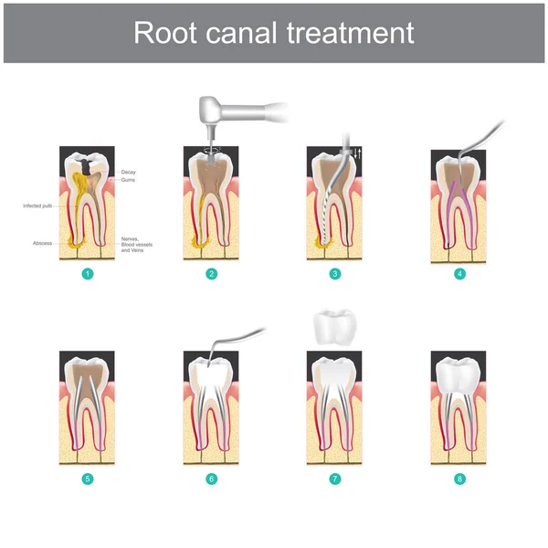 Gyökérkezelés Hogyan Kezeljük Fogak Után Fogat Sérült Vagy Súlyos Fogszuvasodás — Stock Vector