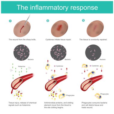 The inflammatory response. When the skin tissue is damaged, the body will produce immunity, eliminate bacteria, together with the new tissue regeneration process. all the response caused by blood vessel and cells fluid in the arteries. clipart