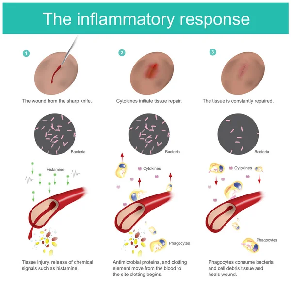 Inflammatory Response Skin Tissue Damaged Body Produce Immunity Eliminate Bacteria — Stock Vector