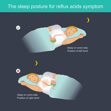When sleeping, Stomach acid can flow back to the oesophagus, causing a burning sensation in chest centre and other symptoms. clipart