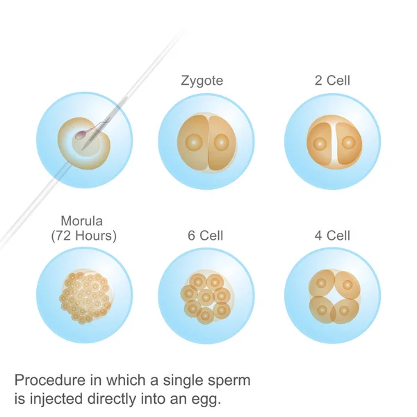 Proceso Que Una Sola Esperma Ilustración Anatomía Cuerpo Humano — Archivo Imágenes Vectoriales