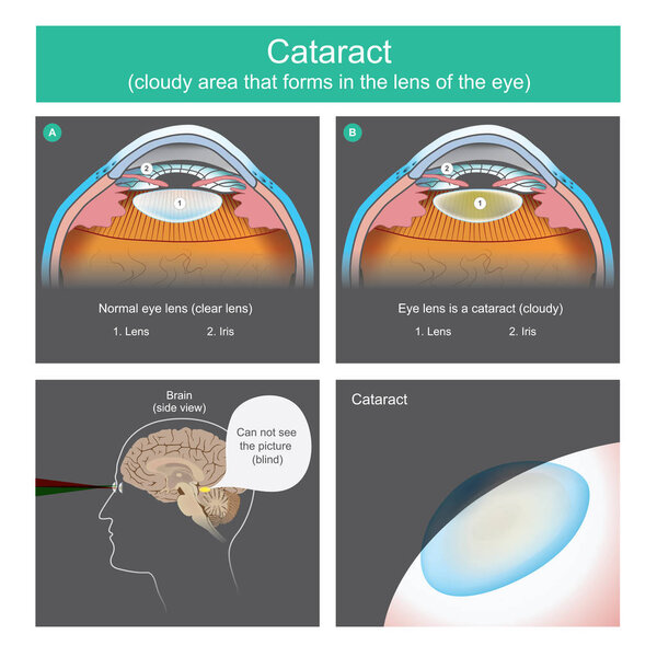 Cataract is a dense cloudy area that forms in the lens of the eye,
