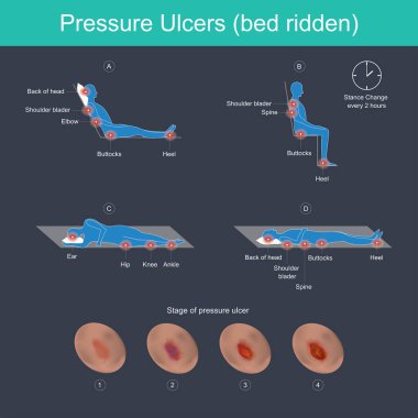 Pressure ulcers are injuries to the skin, primarily caused by prolonged pressure on the skin. They can happen to anyone, but usually affect people confined to bed or who sit in a chair or wheelchair for long periods of time. clipart