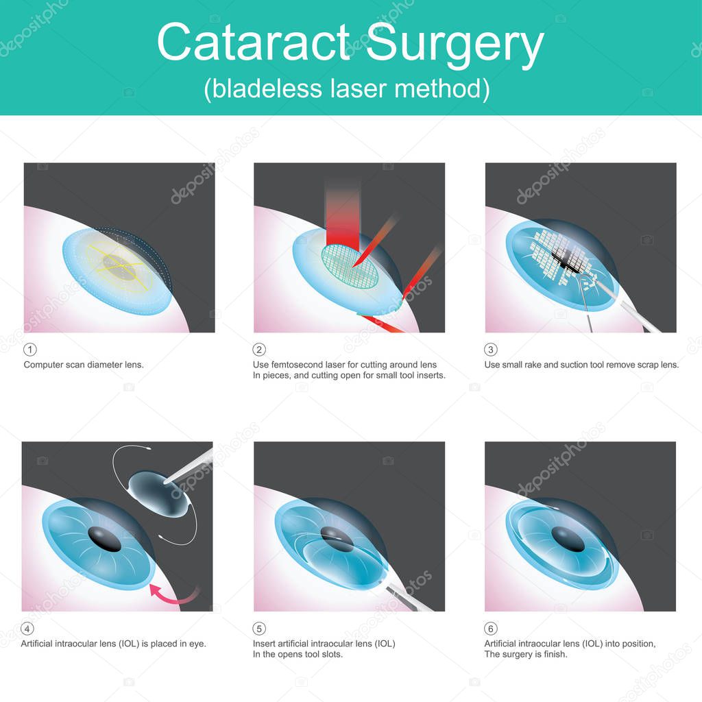 The use of medical lasers to cutting eye lens in small pieces and suction out, in order to use artificial lenses, because the symptoms are cataracts.