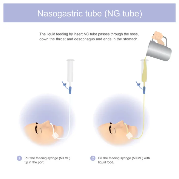 Alimentación Líquida Por Sonda Insertada Pasa Través Nariz Por Garganta — Vector de stock