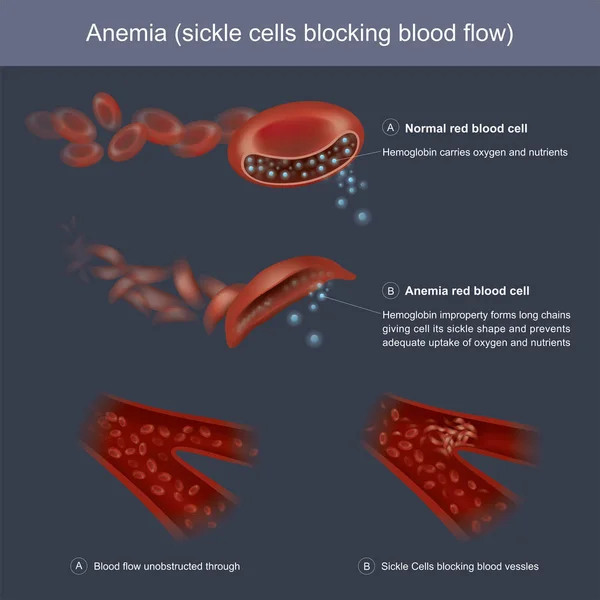 Hemoglobinas indevidamente forma cadeias longas dando célula sua foice —  Vetores de Stock