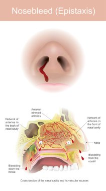 Sinuses kanama arterler gözyaşı tarafından kaynaklanır 