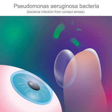 Kontakt lensler, bakteriyel enfeksiyonlar antibiyotiklere dirençli.