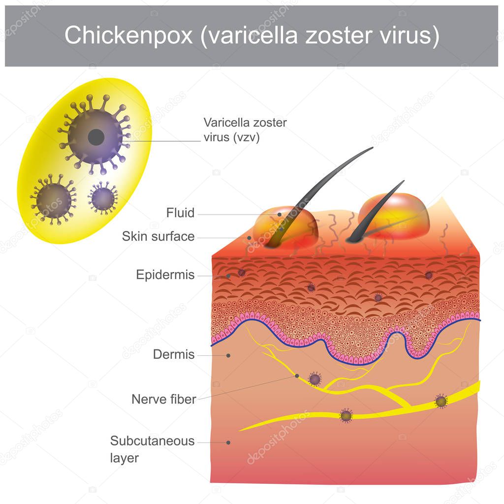 Transmitted by inhalation of varicella virus in aerosol. The skin infections and have a fever. A painful condition caused by nerve damage. Illustration.