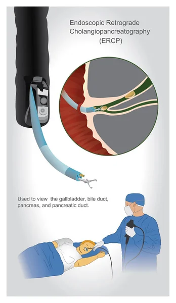 Endoscopische Retrograde Cholangiopancreatografie Ercp Een Onderzoek Gebruikt Bekijken Indien Nodig — Stockvector