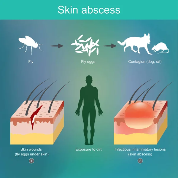 開いた皮膚傷の入っている病原体に起因する皮膚の炎症 — ストックベクタ