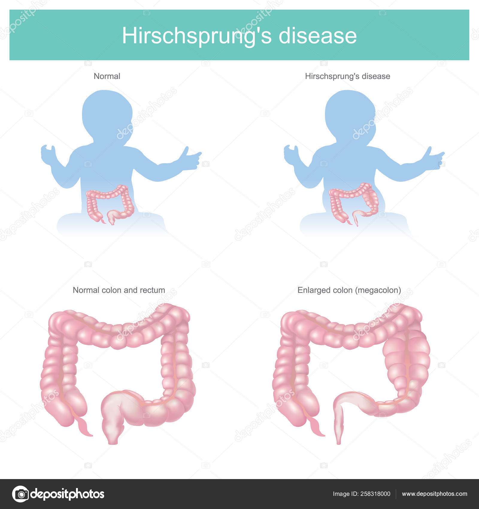 Hirschsprung S Disease Vector Image By C Pattarawit Vector Stock