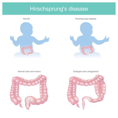 Hirschsprung hastalığı