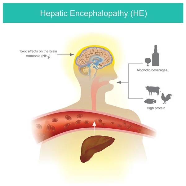 Encefalopatia hepática — Vetor de Stock