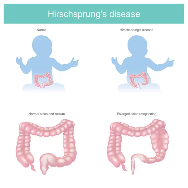 Malattia di Hirschsprung — Vettoriale Stock