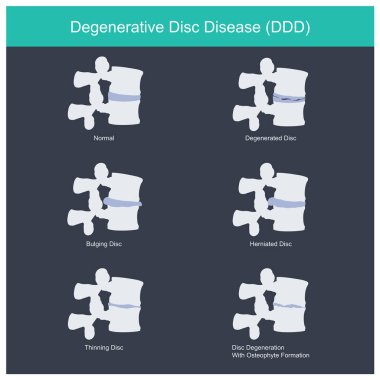 dejeneratif disk hastalığı.