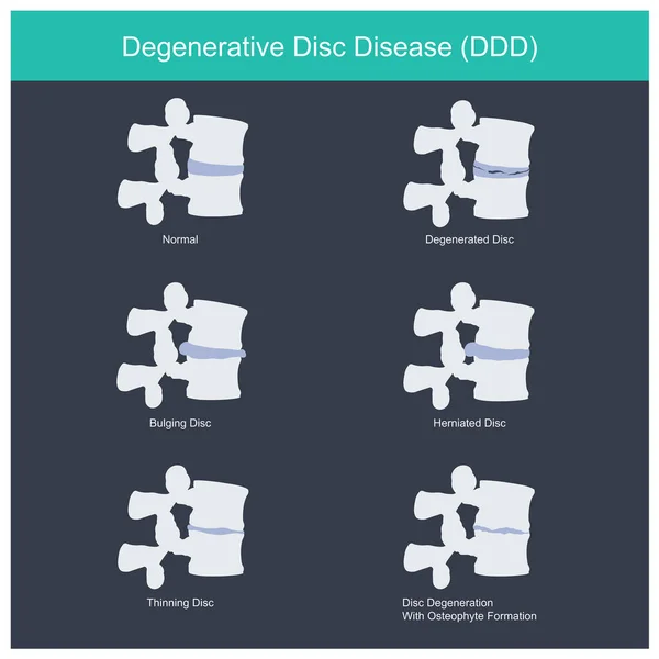 Maladie discale dégénérative . — Image vectorielle