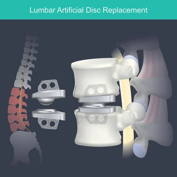 Reemplazo de disco artificial lumbar . — Vector de stock