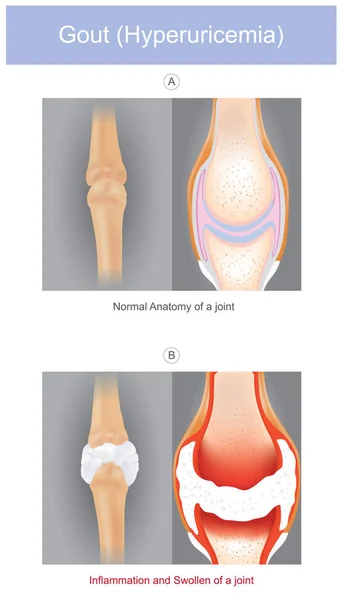 Gicht. die dargestellte Form der Arthritis, die intensiv sein kann — Stockvektor