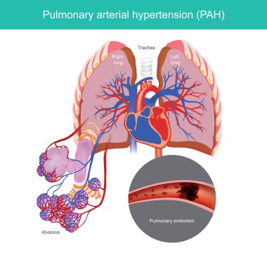 Pulmoner arteriyel hipertansiyon.