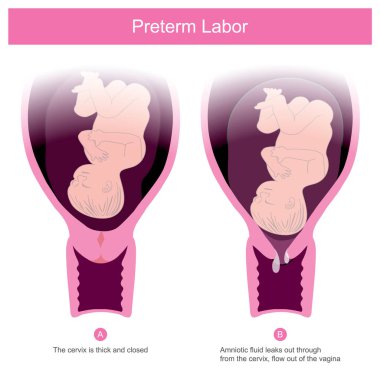 The premature birth, can occur in conditions of amniotic fluid l clipart